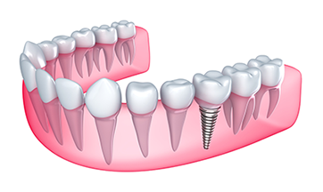 Dental Implants Charleston SC